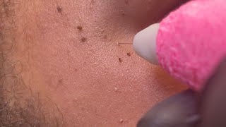 Skin Tag amp DPN Dermatosis Papulosa Nigra Removal [upl. by Busey779]