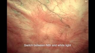 NBI Cystoscopy – Ta lesions  NBI Highlighting Several Recurrences Unseen in White Light [upl. by Gradey]