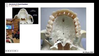 02 maxillary palatal infiltration anesthetic technique [upl. by Crescentia]