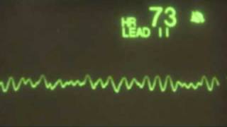 Ventricular Fibrillation  ECG Training Tutorial [upl. by Gaudette]