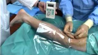 Continuous Popliteal Nerve Block [upl. by Sadick612]