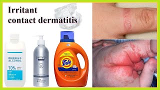 irritant contact dermatitis [upl. by Aisemaj]