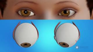 How is strabismus surgery done [upl. by Shing162]