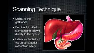 pyloric stenosis [upl. by Trisa]