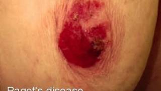 DermTV  Pagets Disease of the Breast DermTVcom 347 [upl. by Nessim50]