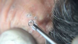 senile Comedones spreading blackheads removal [upl. by Rednazxela306]