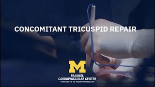 Cardiac Surgery Simplified Concomitant Tricuspid Repair [upl. by Ilujna]