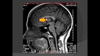 Colloid Cyst Neuroepithelial Cyst [upl. by Astraea]