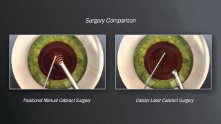 Catalys Laser Cataract Surgery vs Traditional Manual Cataract Surgery  Animation [upl. by Radnaskela926]