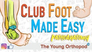 CLUB FOOT Pathoanatomy Made Easy  The Young Orthopod [upl. by Amice]