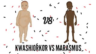 SAM  Severe Acute Malnutrition  Kwashiorkor VS Marasmus [upl. by Rorke337]