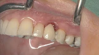 NobelActive clinical case immediate implant placement  Eric Rompen [upl. by Darrill]