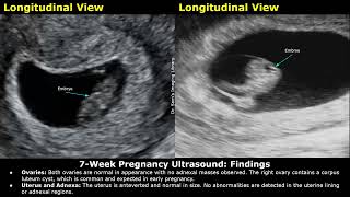 7 Week Pregnancy Obstetric Ultrasound Report Example  Normal Intrauterine Pregnancy USG Reporting [upl. by Ykciv]