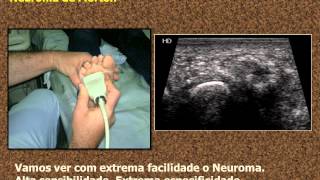 ULTRASOUND OF MORTONS NEUROMA  ULTRASSOM DO NEUROMA DE MORTON [upl. by Vivianna]