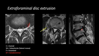 Lumbar Spine MRI by Eric Tranvinh MD Stanford Radiology [upl. by Guglielma]