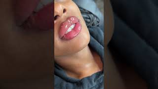 1ml needle less lip fillers touch up using the Hyaluron Pen [upl. by Mehitable]