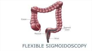 Flexible sigmoidoscopy [upl. by Peedsaj]