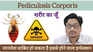 शरीर का जूँ  Body Lice  जानलेवा साबित हो सकता है इससे होने वाला इन्फेक्शन  Pediculosis Corporis [upl. by Mailand]