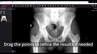 MedDream DICOM Viewer measure the polyline [upl. by Bain]