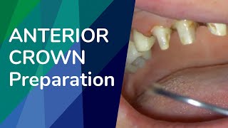 Anterior Crown Preparation for PMF [upl. by Ecerehs239]