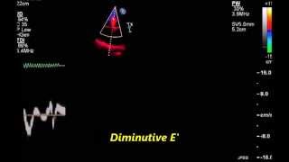 Hypertrophic cardiomyopathy with grade III diastolic dysfunction [upl. by Tansy]