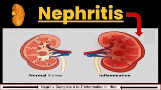 Nephritis in Hindi  Causes Symptoms amp Treatment  Nephrotic Syndrome  Nursing lecture [upl. by Pheni]