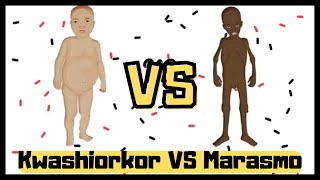 Marasmo  Kwashiorkor diferencias [upl. by Siari]