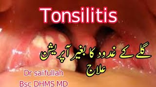 homeopathic medicine for tonsillitis gale k ghadood ka ilaj in urdu hindi tonsil ka ilaj [upl. by Mapes]