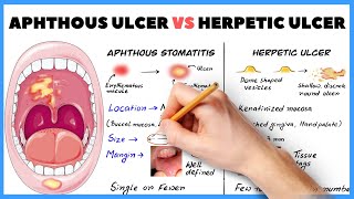 Aphthous ulcer Aphthous stomatitis vs Herpetic ulcer  How to diagnose [upl. by Nonnahsed]