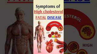 Symptoms of high cholesterol  fatal disease [upl. by Arekahs491]