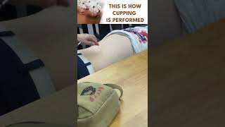 How Cupping is performed [upl. by Adnahc]