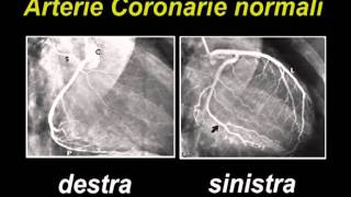 Coronarografia [upl. by Rebane]