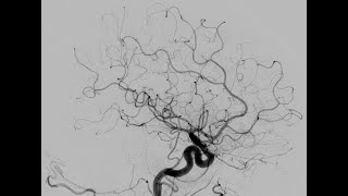 Arteriografía renal  TODO LO QUE DEBES SABER [upl. by Loziram]