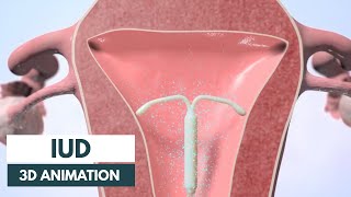 How does an IUD work  3D animation [upl. by Sherris]