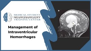 Management of Intraventricular Hemorrhages [upl. by Aralc89]