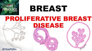 DISEASES OF BREAST Part 2 PROLIFERATIVE BREAST DISEASE [upl. by Ardnoid]