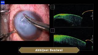 Compression Sutures for Acute Hydrops [upl. by Dream9]