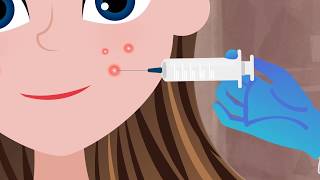 Cortisone Injection for a Big Pimple [upl. by Par]