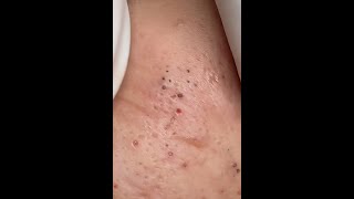 Many blackheads removal [upl. by Randene]