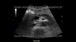 Sonography of pancreas 췌장초음파pancreatic cystic lesionpancreatitispancreas cancer ipmn [upl. by Iraam]