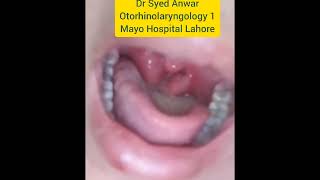 kissing tonsils  Enlarged tonsils  Parenchymatous tonsils  Tonsillectomy Brodski Classification [upl. by Schaaff]