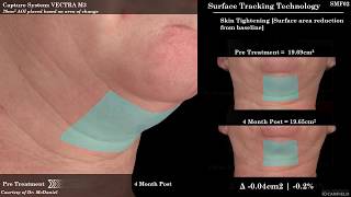 SculpSure for Submental Fat Reduction Under the Chin Fat [upl. by Nari464]