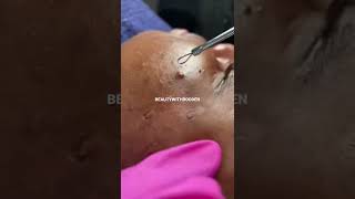 Juicy Blackhead Extractions  Facial Extractions  Toronto Esthetician  Beauty With Bodden [upl. by Eseryt]