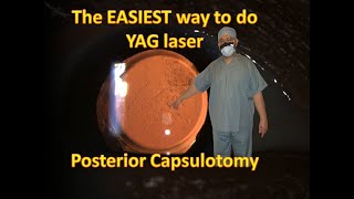 What is the EASIEST way to do YAG laser posterior Capsulotomy [upl. by Madian]