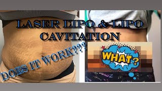 Laser Lipo and lipo cavitation Before amp After Did it work [upl. by Asenaj]