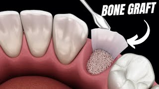 Bone graft What you should NEVER DO [upl. by Matthus35]