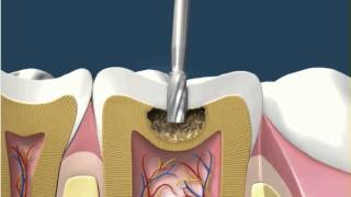 Dental Fillings White Amalgam 1 [upl. by Annodam]