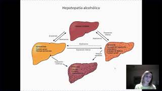 Hepatopatía alcohólica [upl. by Nepil]