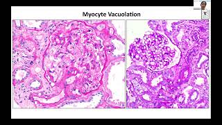 POST RENAL TRANSPLANT DRUG TOXICITY  Dr Vinita Agarwal Lec 9 [upl. by Avie]