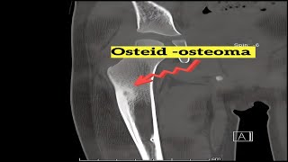 Osteoid Osteoma Insights [upl. by Hastings112]